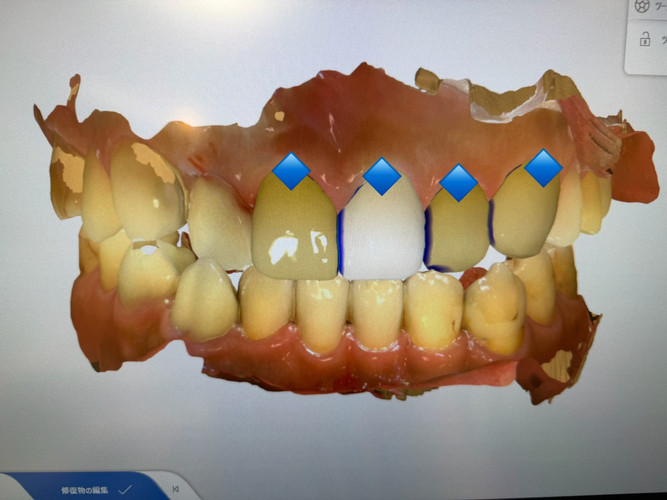 即日審美歯科治療における３D／CAD上での歯のデザインの様子。青印がセラミックのデザインが終わったところ。