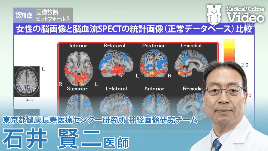 認知症 画像診断