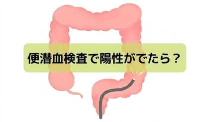 痔（じ）と勘違い？！便潜血検査で「陽性」も”症状無し”で手遅れに。