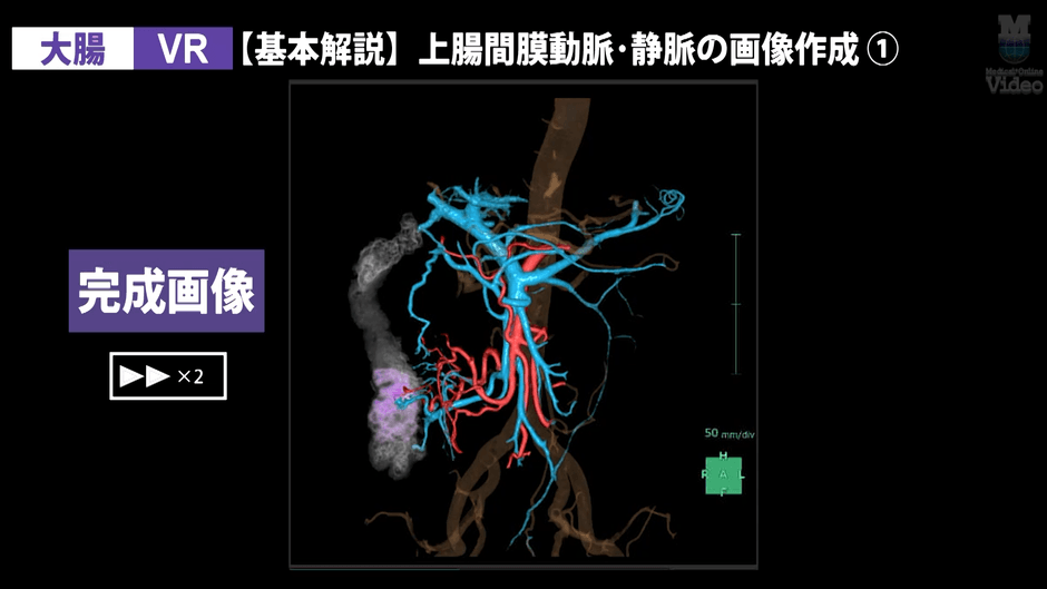 3DCT 大腸