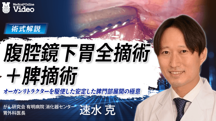 腹腔鏡下胃全摘術+脾摘術