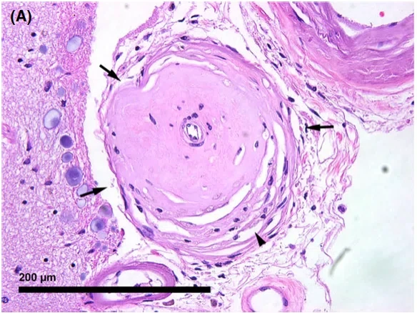 C.Zarow et al. Neuropathology and applied neurobiology 2018