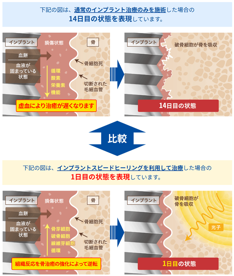 インプラント治療時間を短縮できる理由