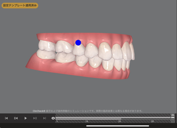 奥歯がまだ理想的なかみ合わせではないが、まずは患者様が気にされている「出っ歯」の改善をメインにした矯正治療（治療後イメージ）