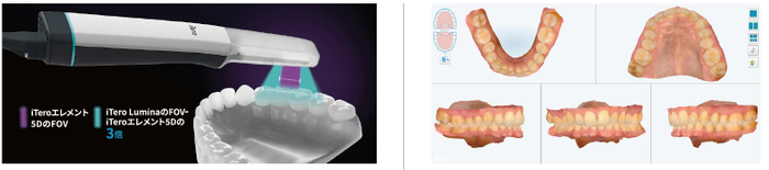 新型口腔内スキャナ「iTero」は先進的なAI技術を搭載