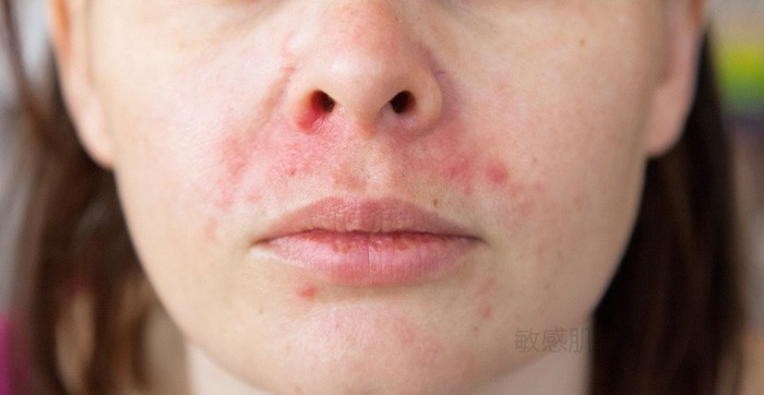 脂漏性皮膚炎の症状例