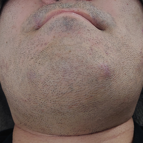 [ヒゲ脱毛施術中の男性写真]