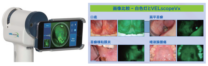 画像比較　白色灯とVELscope VX