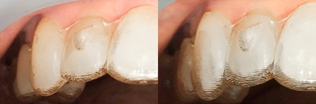 アライナーの不適合