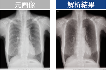 骨信号減弱機能イメージ