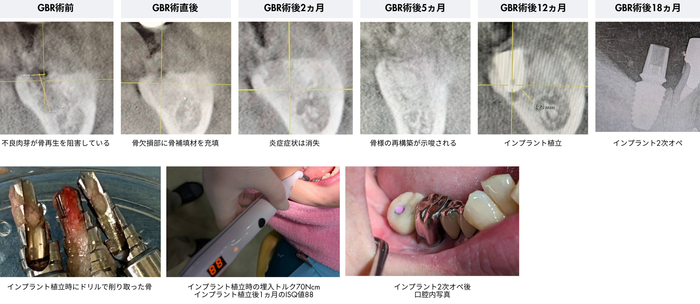 GBRからインプラント植立までの推移