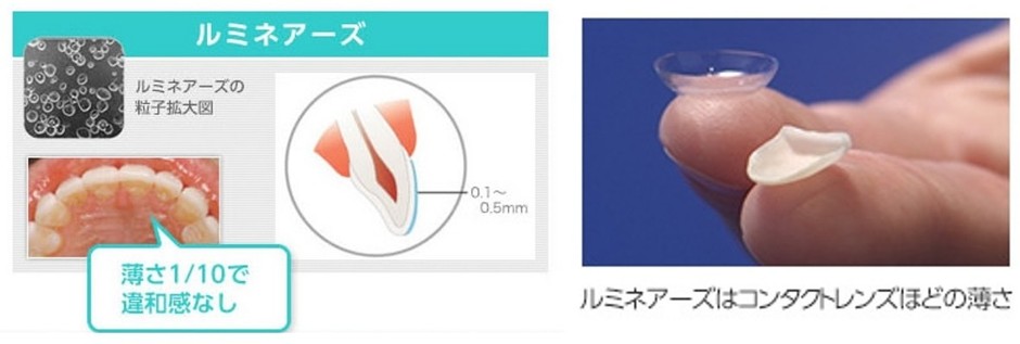 コンタクトレンズ級の極薄セラミックで、痛みを抑えて理想の白い歯へ
