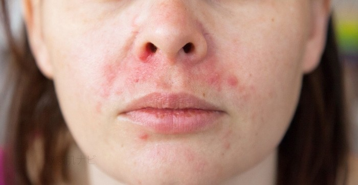 脂漏性皮膚炎　酒さ