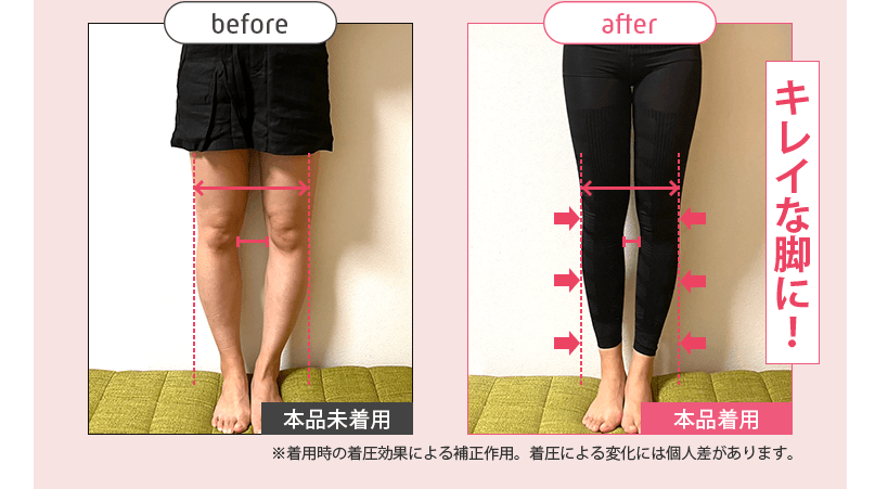 ストレグO脚Before/After