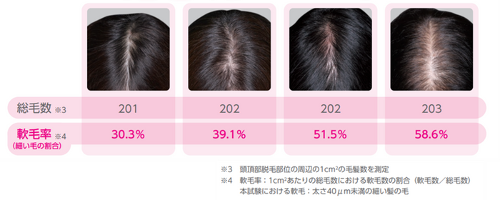 壮年性脱毛症の頭髪写真