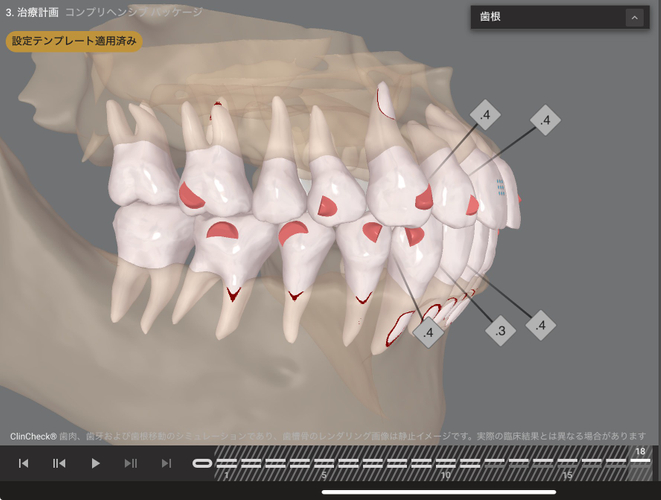 Drによるプランニングシミュレーション（23 &rarr; 18ステージ）