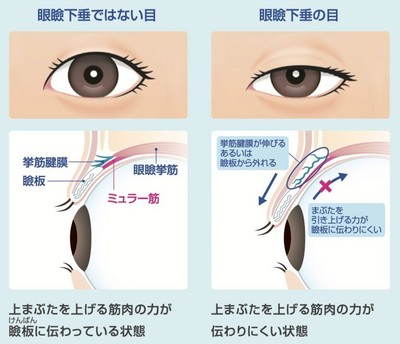 眼瞼下垂とは