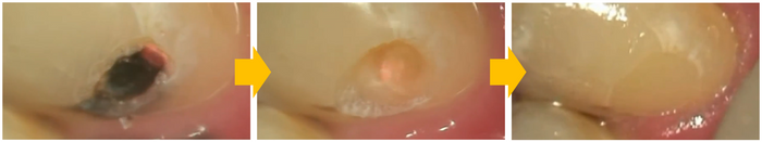 レーザー治療「削る」から「蒸散」へ