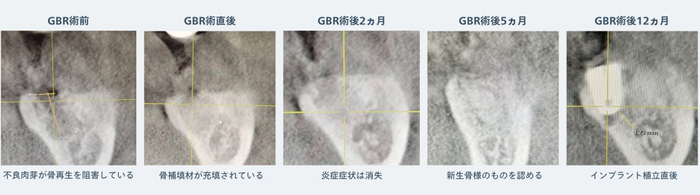 GBRからインプラント植立までのCBCT画像