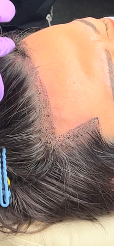 スカルプイメージです！生え際が気になる方も！